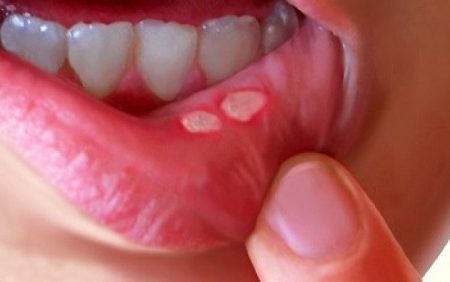 Cứ bị NHIỆT MIỆNG lại lôi ngay bài thuốc này ra xài là hết ngay, không tốn 1 xu nào