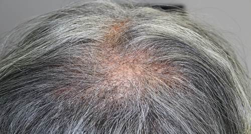 Cây thuốc nam chữa Rụng tóc tóc bạc sớm
