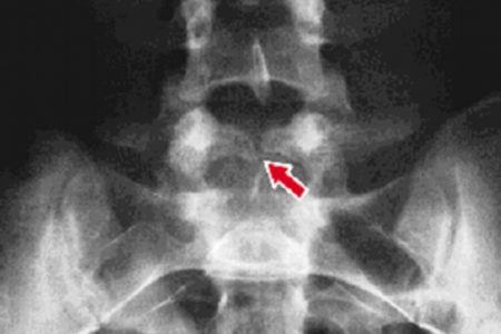 Vui quá mọi người ơi: Ai bị gai cột sống thì không nên bỏ qua bài thuốc cực đơn giản này – 100 người dùng có đến 99 người đã khỏi nhé