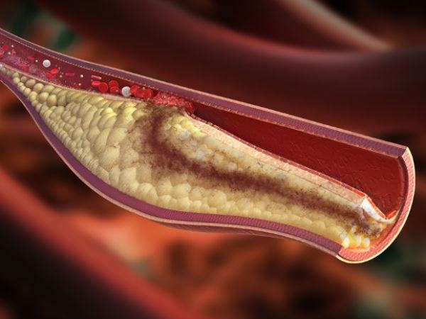 Công thức quét sạch mỡ máu, huyết áp cao cấp tốc
