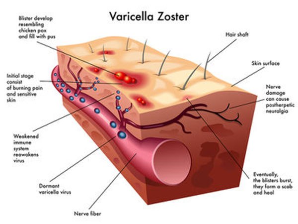 Bệnh zona do virus Varicella Zoster gây ra, lần đầu khi chúng xâm nhập cơ thể người sẽ gây nên bệnh thủy đậu