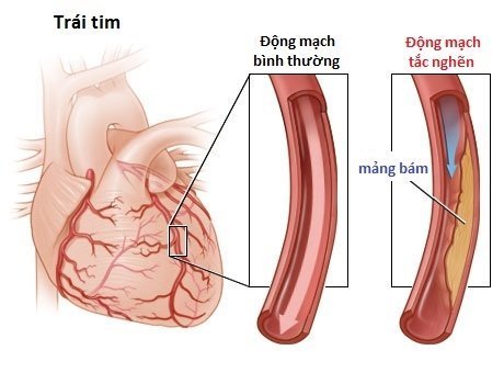 Căn bệnh còn ảnh hưởng rất lớn đến tim mạch